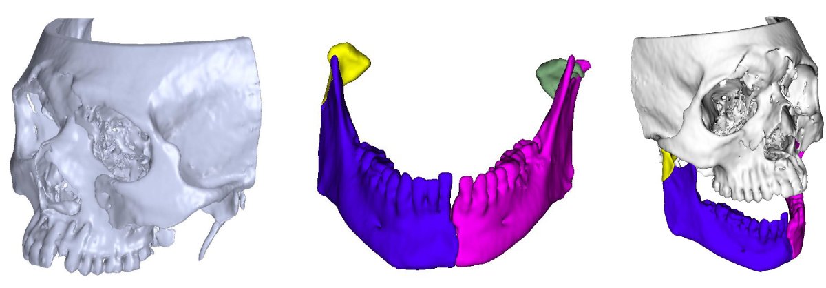 ricostruzione volto stampa 3d tac
